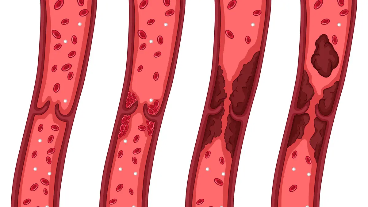 How Sugar Clogs Your Internal Pipes?