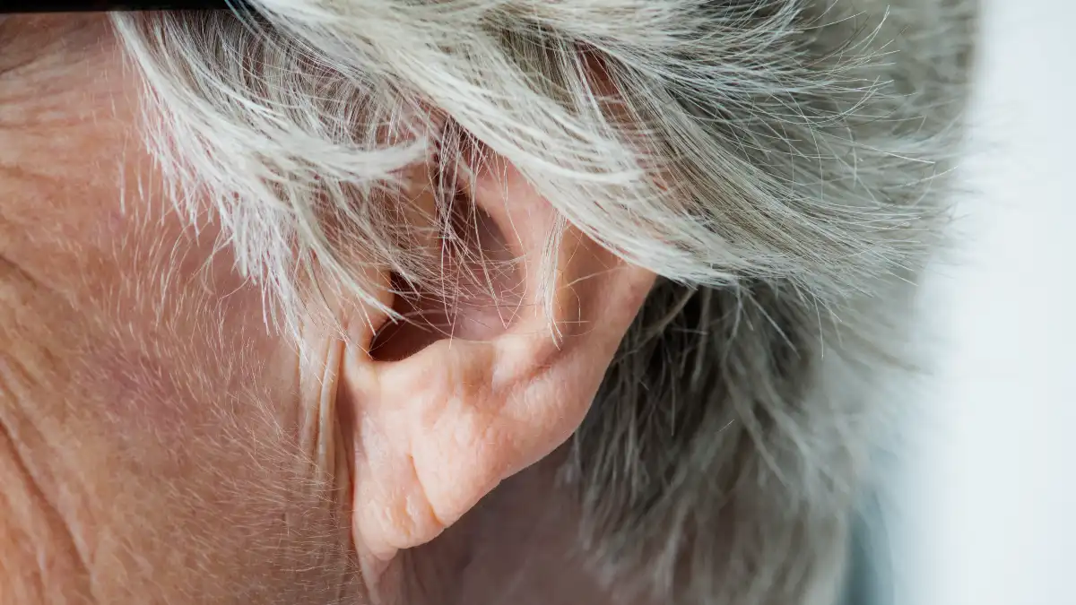 Close up of Frank’s Sign on a mature earlobe, a visible indicator linked to atherosclerosis and heart risk.