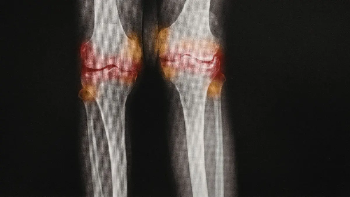 X-ray of human knees against a black background, showing the joint area glowing with a bright red and orange heat map effect to symbolize intense inflammation and arthritis pain.