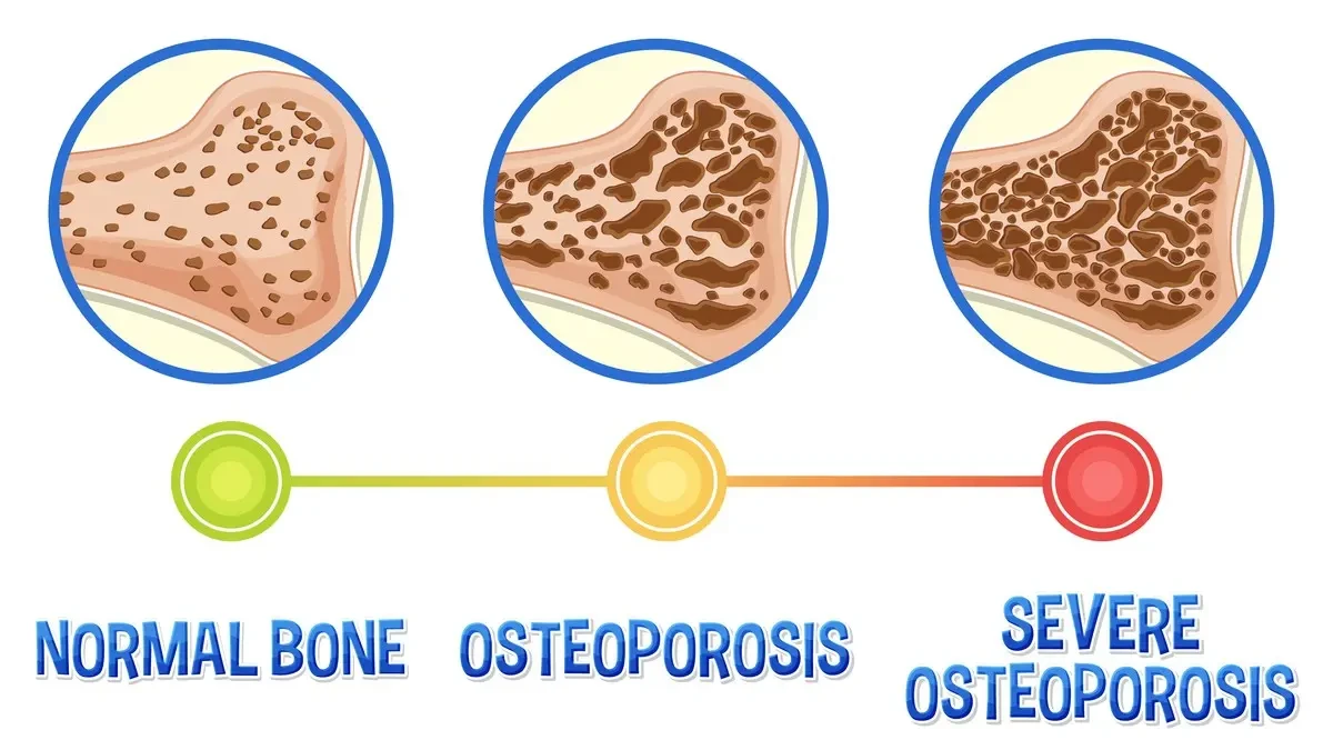 Medical illustration comparing healthy bone density to the porous structure of osteopenia to show how the remodeling balance shifts after 50. 