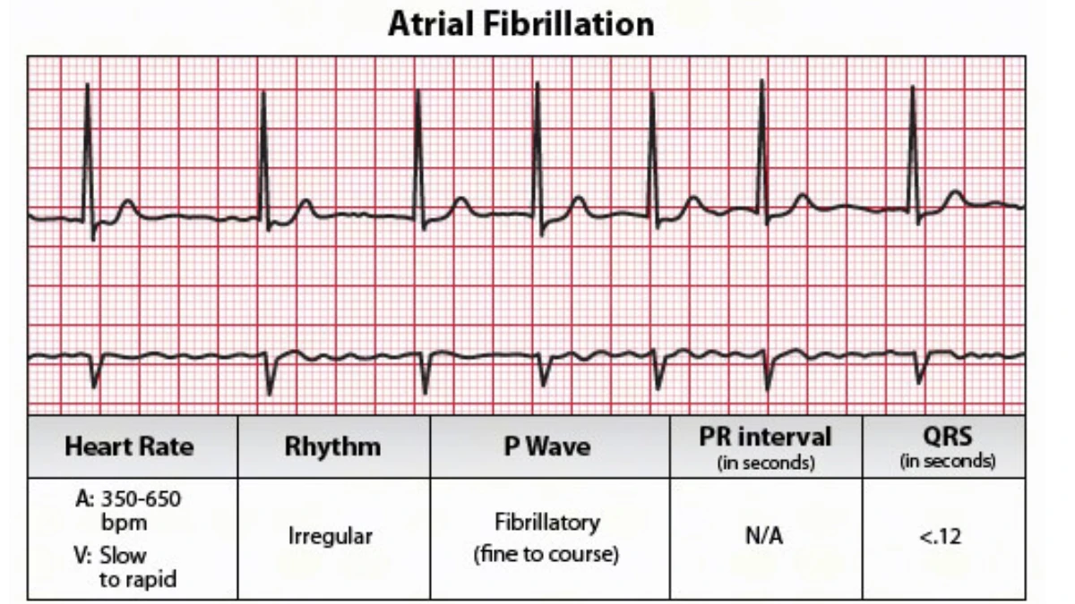 An ECG rhythm strip of atrial fibrillation showing an irregular heartbeat pattern with a heart rate of 350 to 650 beats per minute, fibrillatory P waves, and a data table summarizing the irregular rhythm, confirming how AFib disrupts efficient blood pumping and reduces oxygen delivery during physical activity.