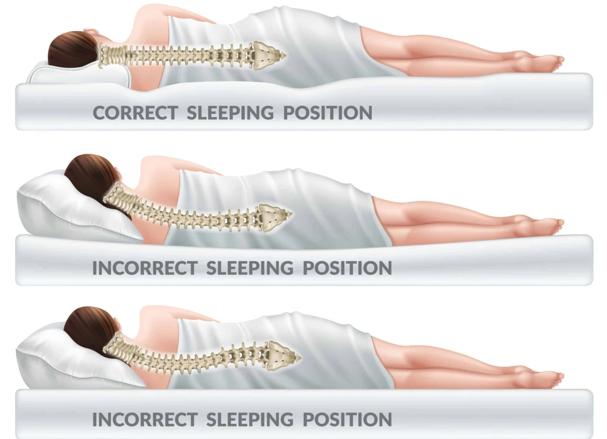 A three-panel medical illustration comparing correct and incorrect sleeping positions, showing how spinal alignment is affected by mattress firmness β supporting the recommendation of medium-firm mattresses to reduce fascial tension and back stiffness during sleep.