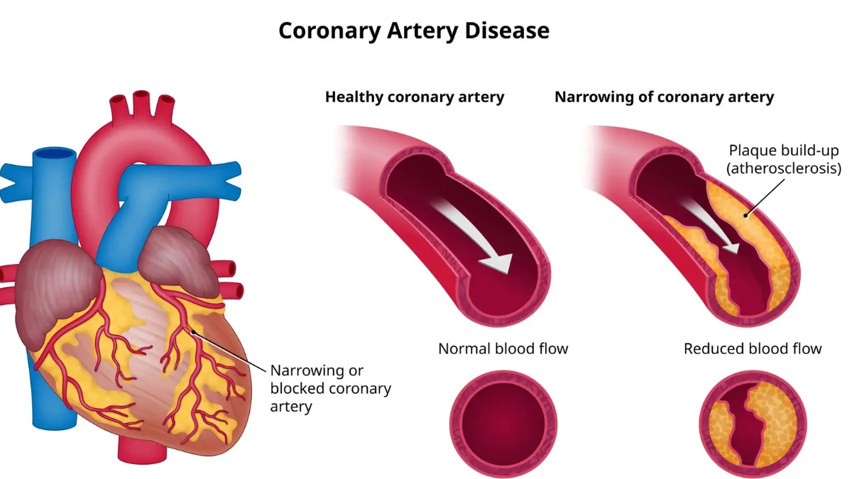 A medical illustration of Coronary Artery Disease showing a heart with blocked coronary arteries alongside a comparison of a healthy artery with normal blood flow versus a narrowed artery with plaque buildup reducing blood flow to the heart.