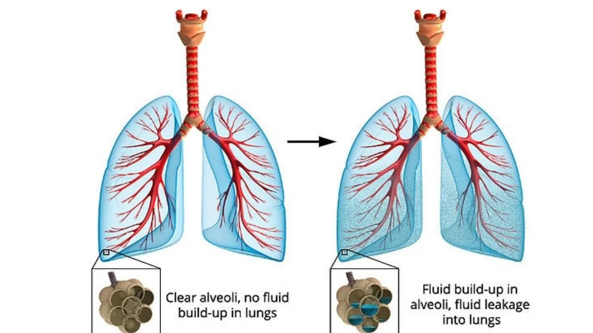 A side-by-side medical illustration comparing healthy lungs with clear alveoli to lungs affected by heart failure, showing fluid leakage and buildup in the air sacs that makes breathing difficult during physical effort.