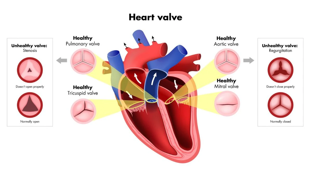 A medical illustration of heart valve disease showing all four heart valves — pulmonary, aortic, tricuspid, and mitral — with close-up comparisons of healthy valves against unhealthy valves affected by stenosis, which doesn't open properly, and regurgitation, which doesn't close properly.